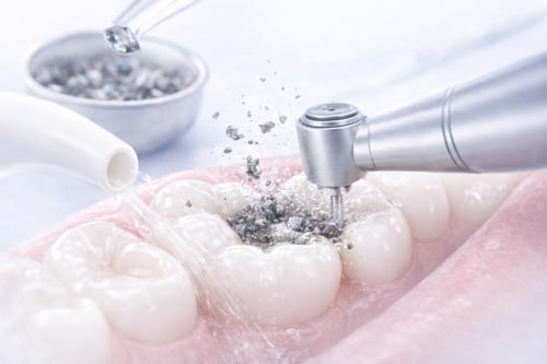 vorschau_amalgam-sanierung